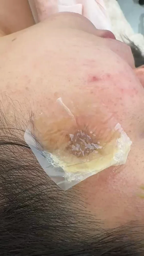 Adesivo FREESKIN aplicado sobre a mancha